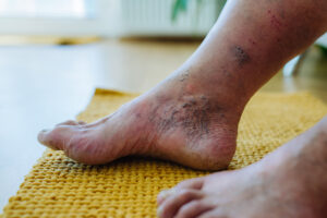 How Comprehensive Diabetic Foot Ulcer Management Improves Outcomes for Patients